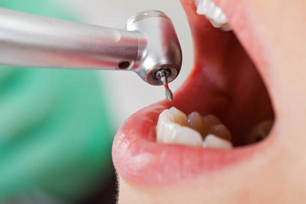Best Emergency Wisdom Teeth Removal in New Athens, IL